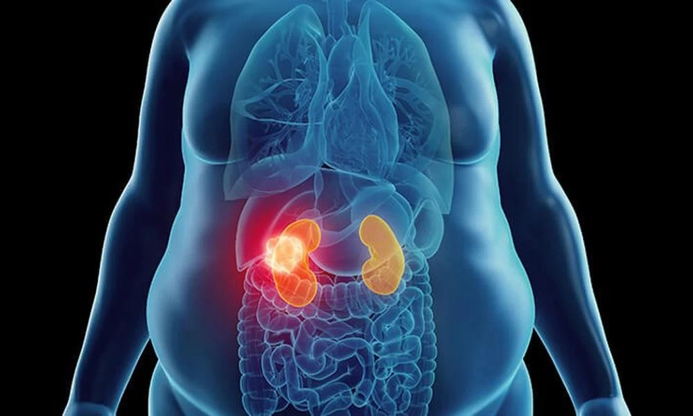 Καρκίνος: Λιγότερα κιλά, μικρότερος κίνδυνος να νοσήσουμε